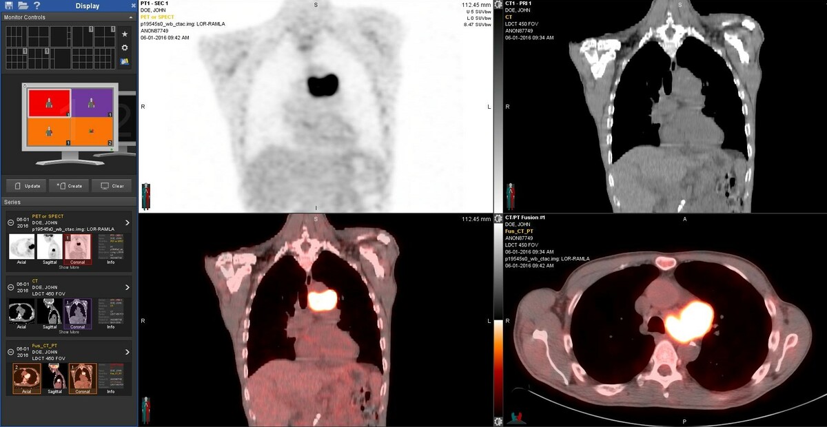 PET/CT scan showing hypermetabolic tumor within the chest.